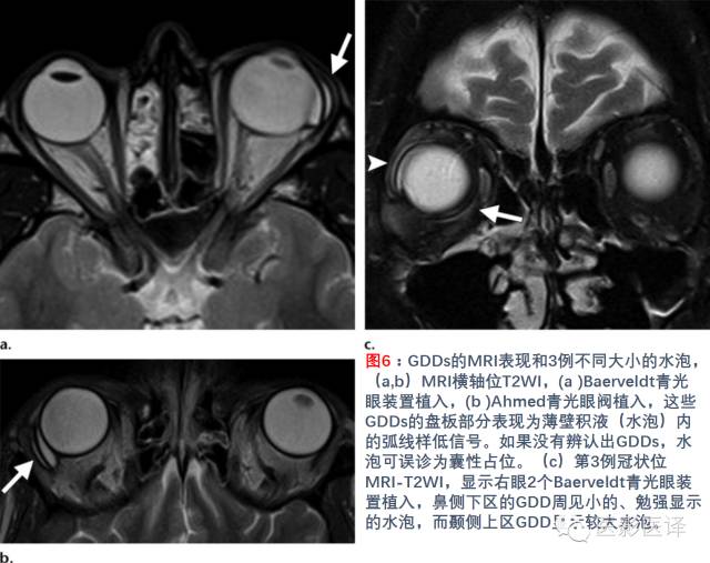 眼眶内容物术后影像学表现 眼眶内容物术后影像学表现