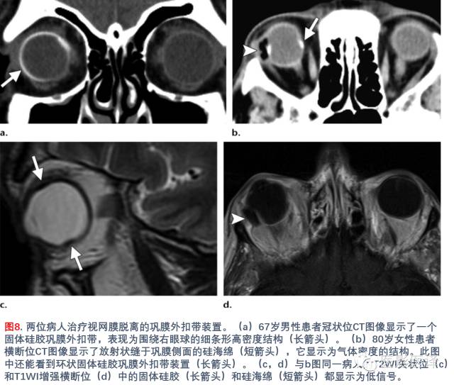 眼眶内容物术后影像学表现 眼眶内容物术后影像学表现