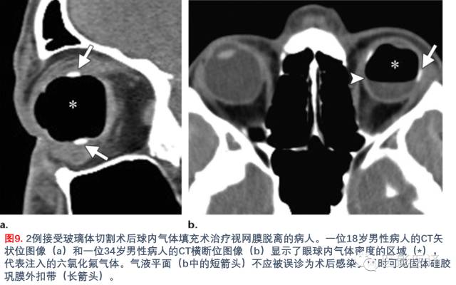 眼眶内容物术后影像学表现 眼眶内容物术后影像学表现