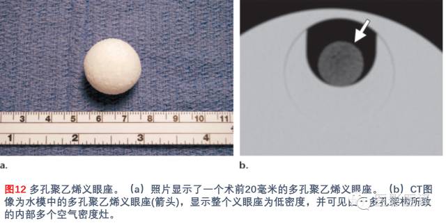 眼眶内容物术后影像学表现 眼眶内容物术后影像学表现