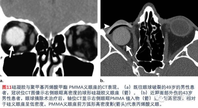 眼眶内容物术后影像学表现 眼眶内容物术后影像学表现