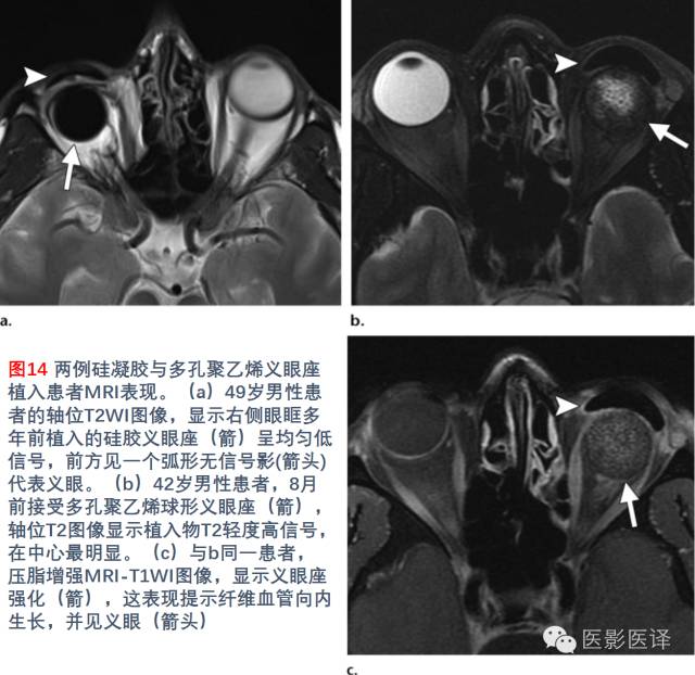 眼眶内容物术后影像学表现 眼眶内容物术后影像学表现