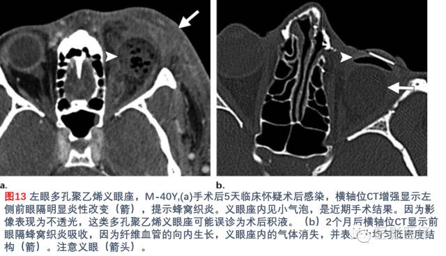 眼眶内容物术后影像学表现 眼眶内容物术后影像学表现