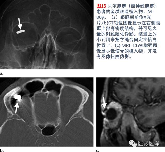 眼眶内容物术后影像学表现 眼眶内容物术后影像学表现