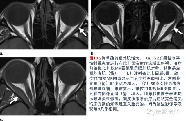 眼眶内容物术后影像学表现 眼眶内容物术后影像学表现