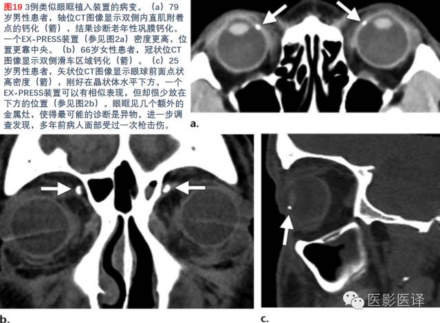 眼眶内容物术后影像学表现 眼眶内容物术后影像学表现