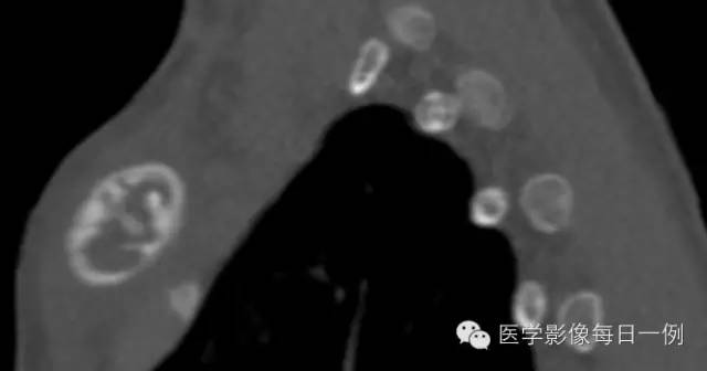 【病例】慢性复发性多灶性骨髓炎1例CT及MR 【病例】慢性复发性多灶性骨髓炎1例CT及MR