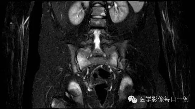 【病例】慢性复发性多灶性骨髓炎1例CT及MR 【病例】慢性复发性多灶性骨髓炎1例CT及MR