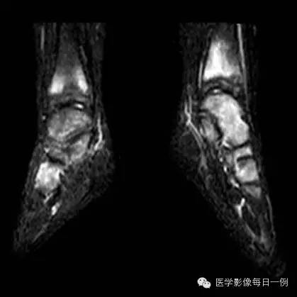 【病例】慢性复发性多灶性骨髓炎1例CT及MR 【病例】慢性复发性多灶性骨髓炎1例CT及MR