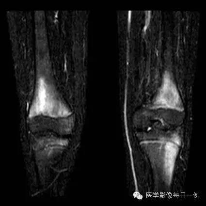 【病例】慢性复发性多灶性骨髓炎1例CT及MR 【病例】慢性复发性多灶性骨髓炎1例CT及MR