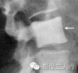 "象牙椎"，这个征象提示啥？