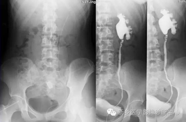 先天性输尿管狭窄