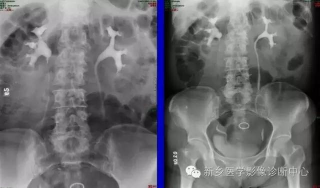 先天性输尿管狭窄 先天性输尿管狭窄