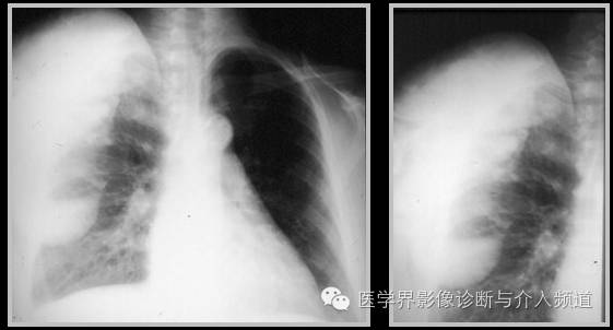 25张平片,带你了解软组织钙化和骨化 25张平片,带你了解软组织钙化和骨化