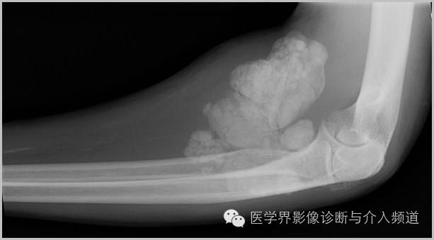25张平片，带你了解软组织钙化和骨化