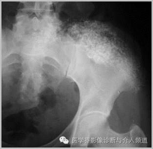 25张平片,带你了解软组织钙化和骨化 25张平片,带你了解软组织钙化和骨化