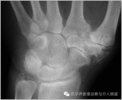 25张平片,带你了解软组织钙化和骨化 25张平片,带你了解软组织钙化和骨化