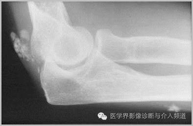 25张平片,带你了解软组织钙化和骨化 25张平片,带你了解软组织钙化和骨化
