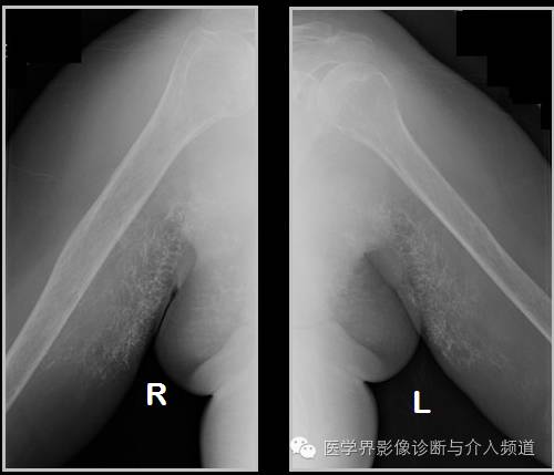 25张平片,带你了解软组织钙化和骨化 25张平片,带你了解软组织钙化和骨化
