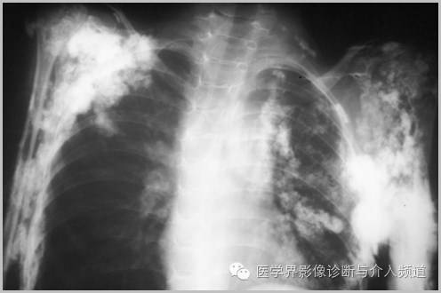 25张平片,带你了解软组织钙化和骨化 25张平片,带你了解软组织钙化和骨化