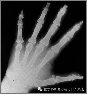 25张平片,带你了解软组织钙化和骨化 25张平片,带你了解软组织钙化和骨化