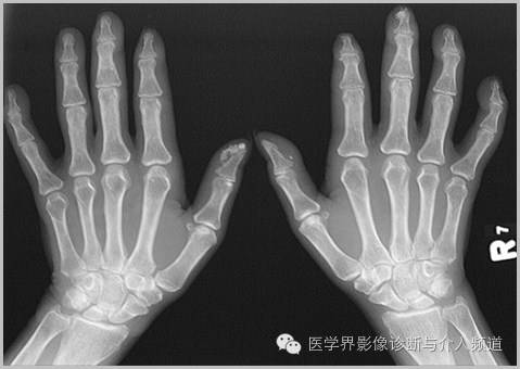 25张平片,带你了解软组织钙化和骨化 25张平片,带你了解软组织钙化和骨化