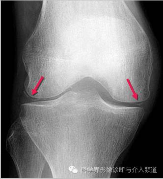 25张平片,带你了解软组织钙化和骨化 25张平片,带你了解软组织钙化和骨化