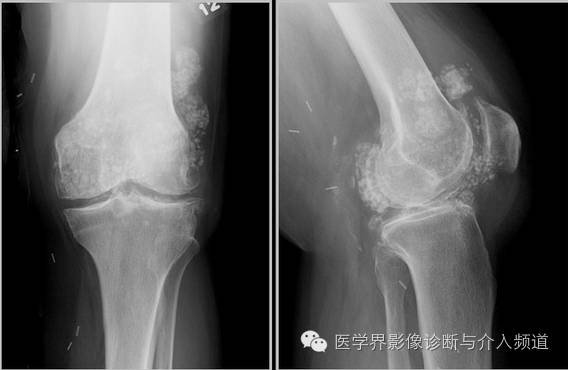 25张平片,带你了解软组织钙化和骨化 25张平片,带你了解软组织钙化和骨化