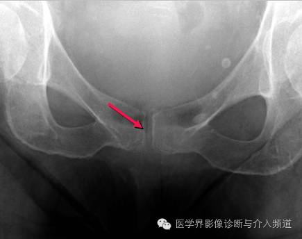 25张平片,带你了解软组织钙化和骨化 25张平片,带你了解软组织钙化和骨化