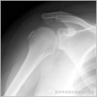 25张平片,带你了解软组织钙化和骨化 25张平片,带你了解软组织钙化和骨化