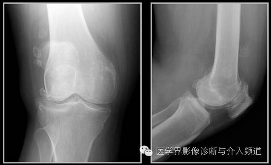 25张平片,带你了解软组织钙化和骨化 25张平片,带你了解软组织钙化和骨化