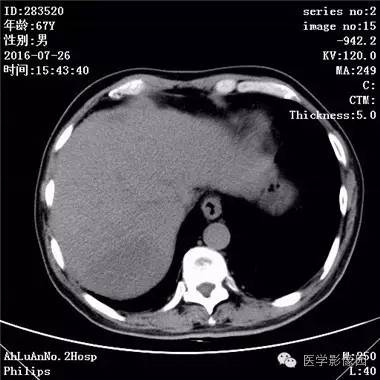 【病例】肝脏多发脓肿1例CT影像表现