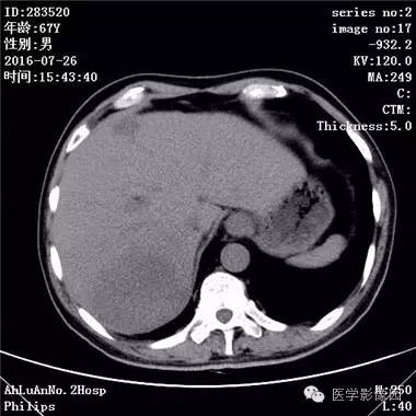 【病例】肝脏多发脓肿1例CT影像表现