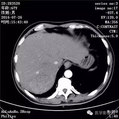 【病例】肝脏多发脓肿1例CT影像表现