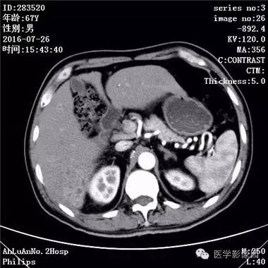 【病例】肝脏多发脓肿1例CT影像表现