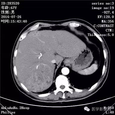 【病例】肝脏多发脓肿1例CT影像表现