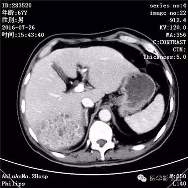 【病例】肝脏多发脓肿1例CT影像表现