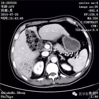 【病例】肝脏多发脓肿1例CT影像表现