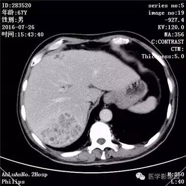 【病例】肝脏多发脓肿1例CT影像表现