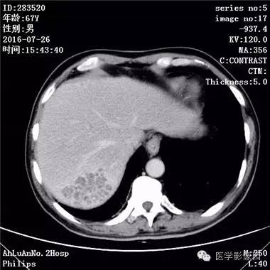 【病例】肝脏多发脓肿1例CT影像表现