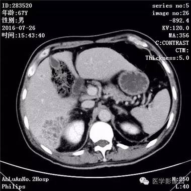 【病例】肝脏多发脓肿1例CT影像表现