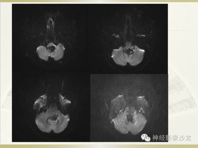 【病例】四脑室室管膜瘤1例CT影像表现