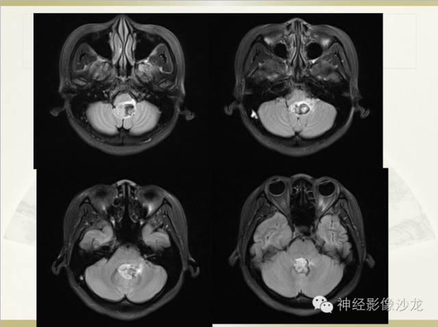【病例】四脑室室管膜瘤1例CT影像表现