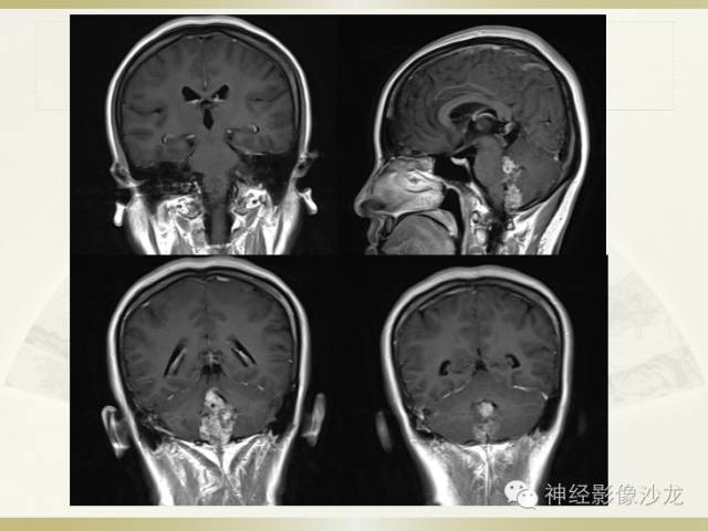 【病例】四脑室室管膜瘤1例CT影像表现