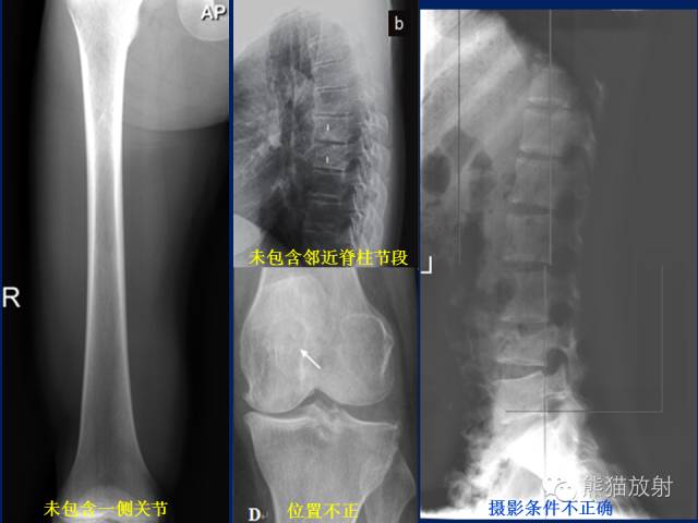 【PPT】骨关节影像学检查技术要求与诊断要点