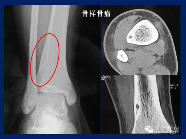 【PPT】骨关节影像学检查技术要求与诊断要点