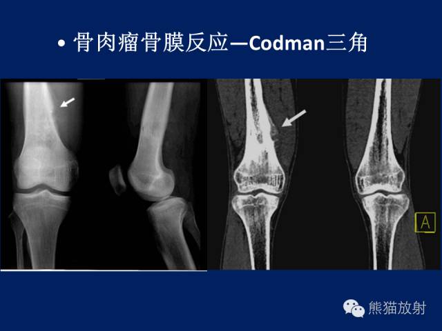 【PPT】骨关节影像学检查技术要求与诊断要点