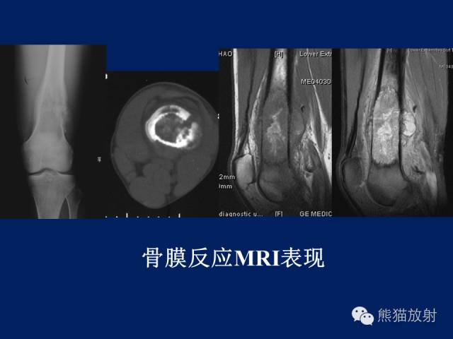 【PPT】骨关节影像学检查技术要求与诊断要点