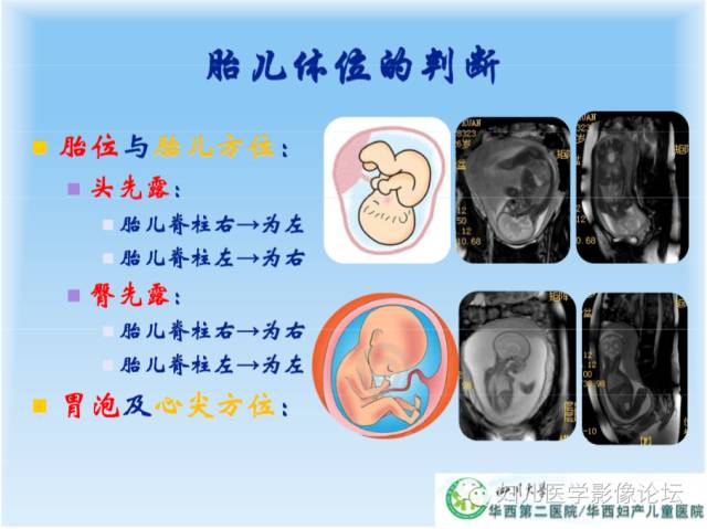 【PPT】胎儿颅脑常见先天异常MRI诊断