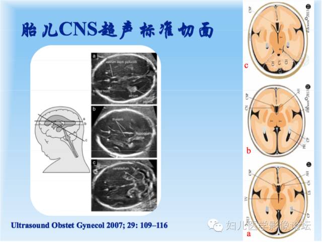 【PPT】胎儿颅脑常见先天异常MRI诊断